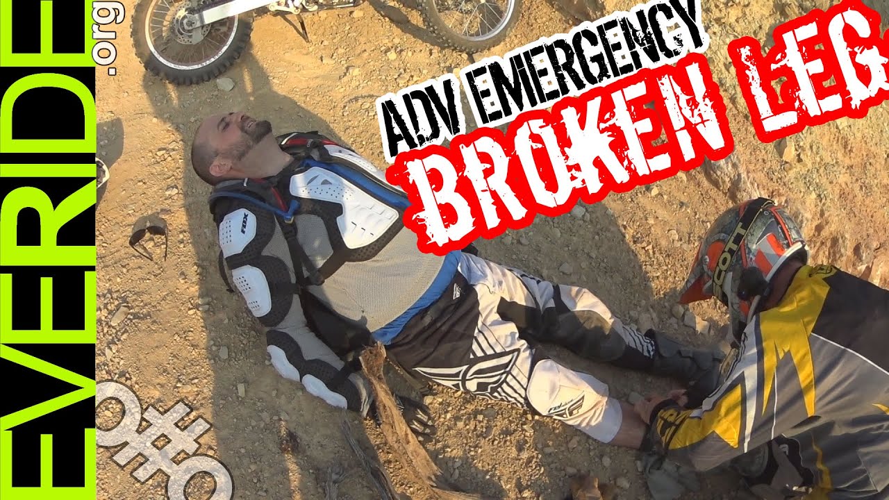 leg fractures occur without dirt bike boots
