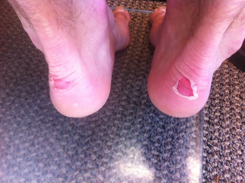 blisters due to wearing dirt bike boots