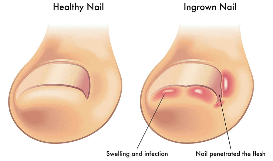 ingrown toenail because of wearing tight dirt bike boots